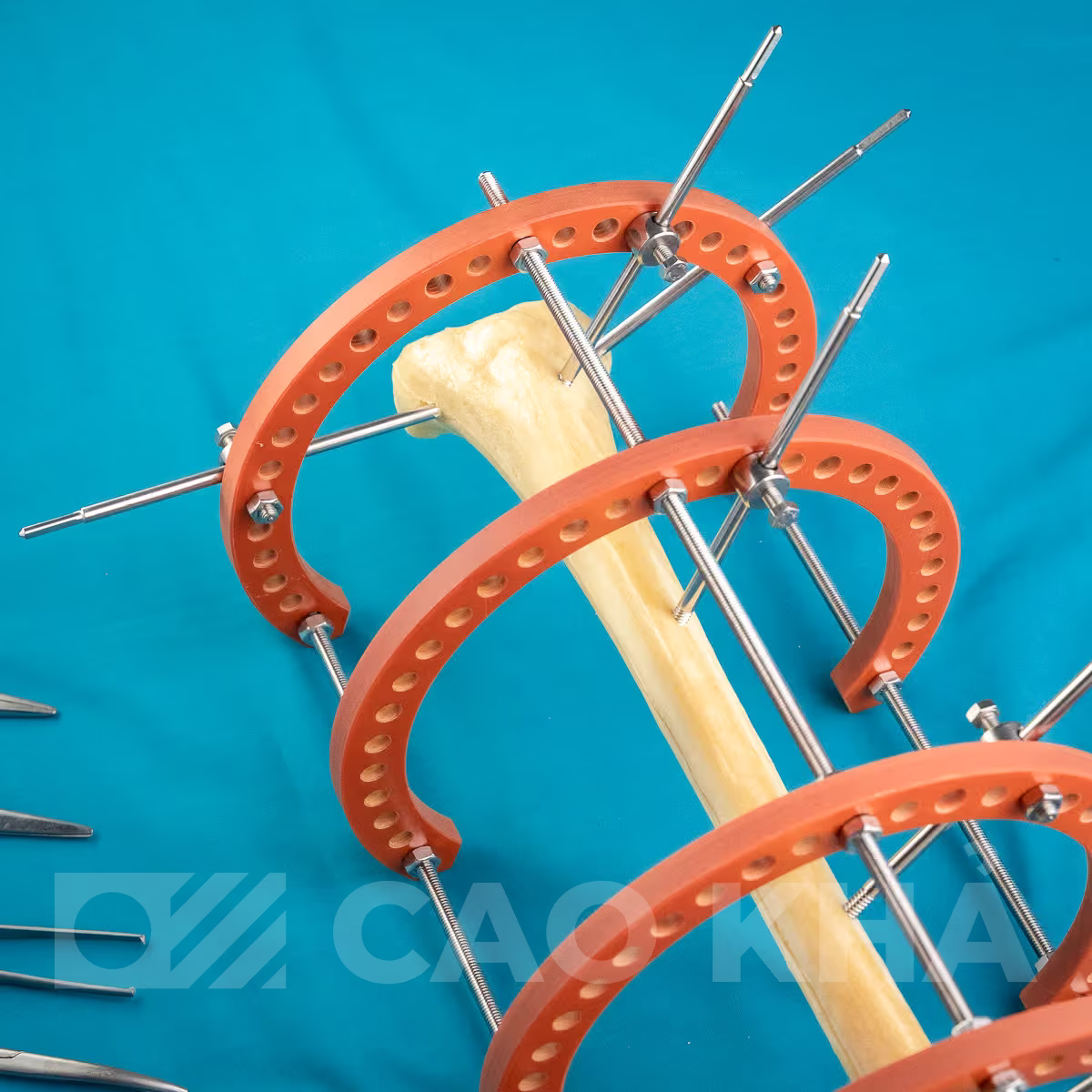 Cố định ngoài Ilizarov không cản quang - góc nhìn 4