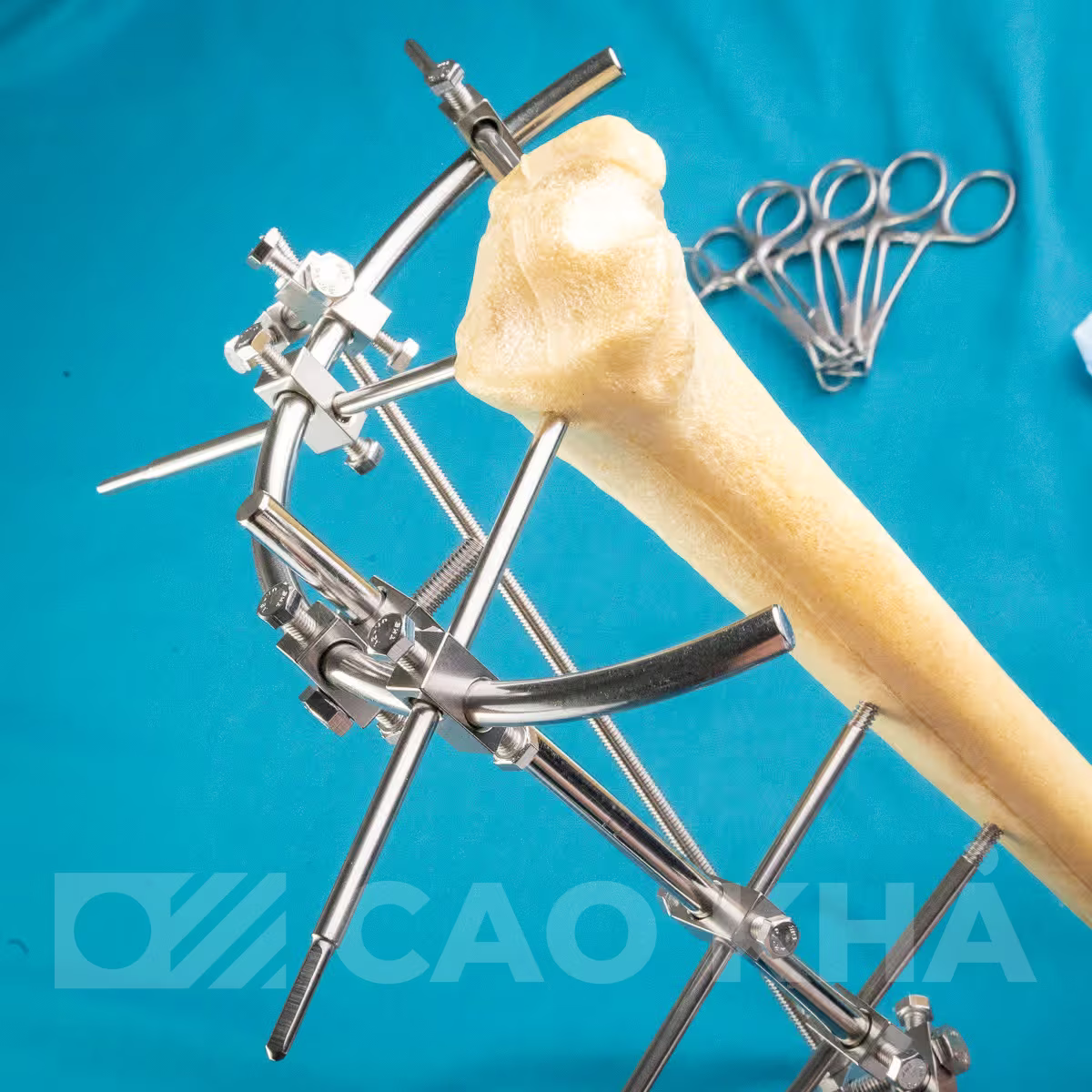 Cố định ngoài Gần khớp - góc nhìn 3