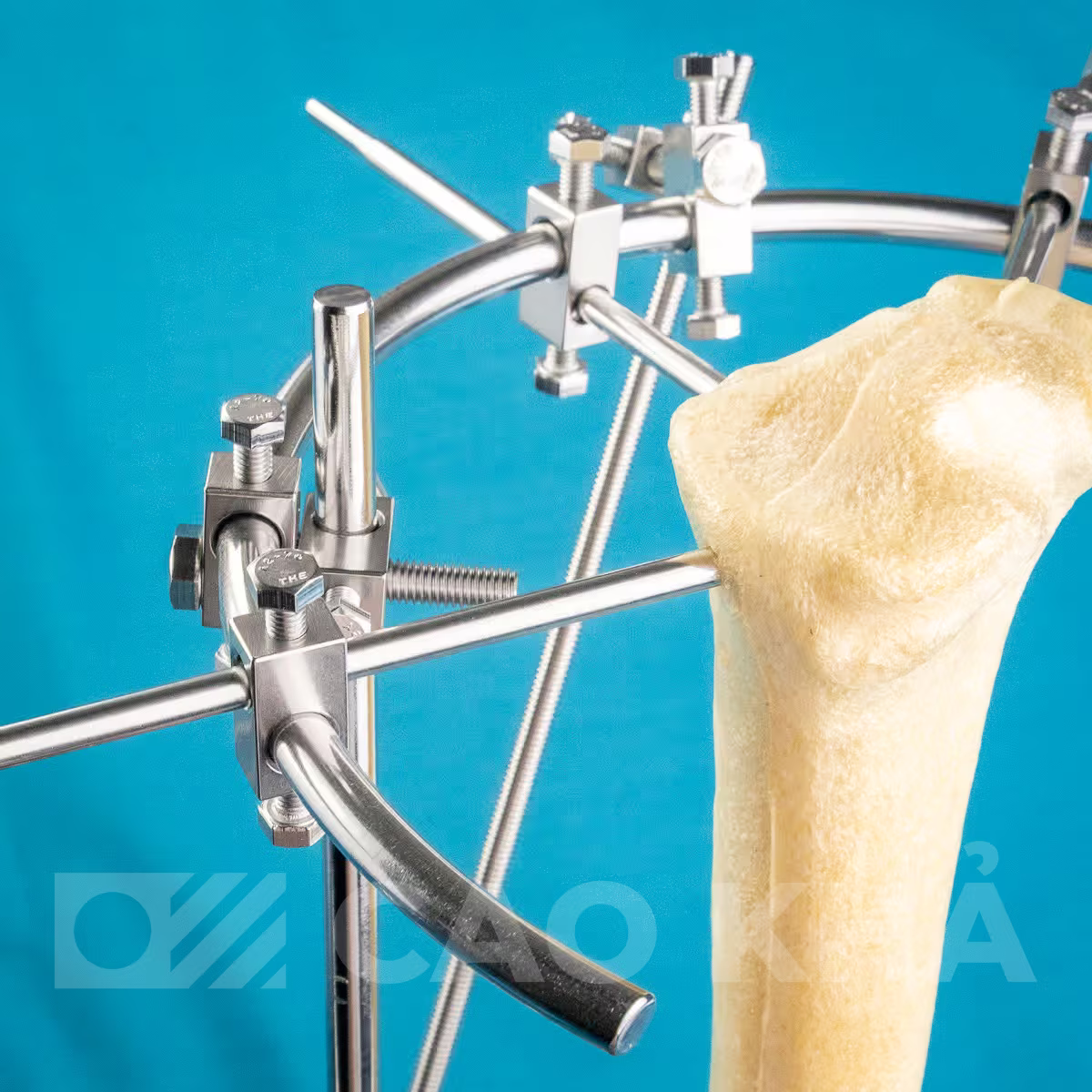Cố định ngoài Gần khớp - góc nhìn 4