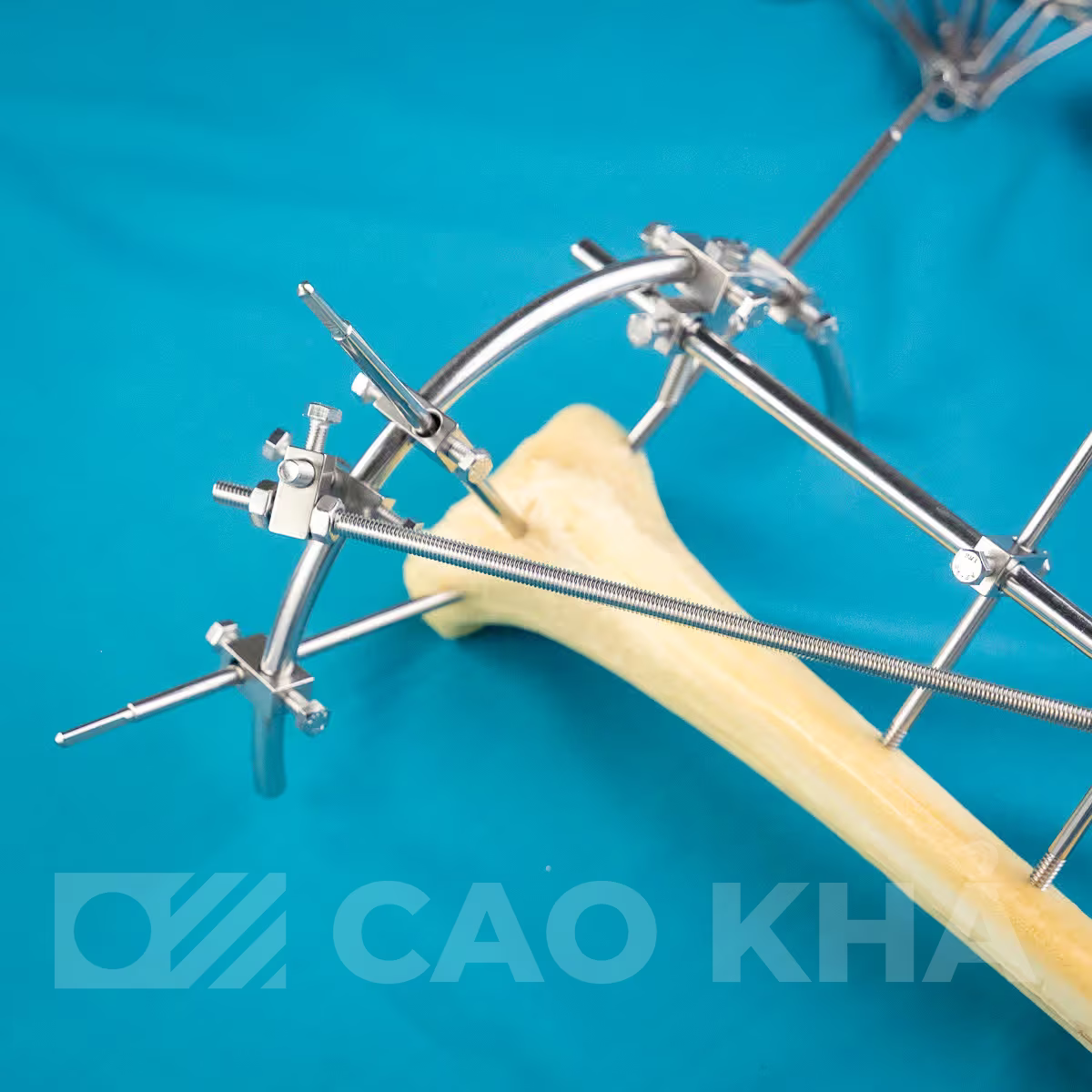 Cố định ngoài Gần khớp - góc nhìn 5