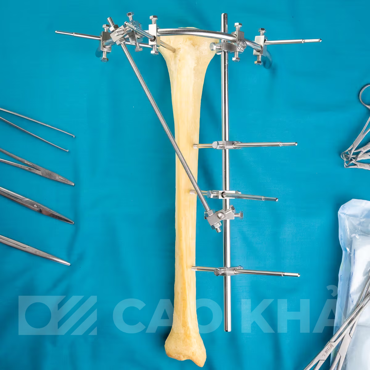 Cố định ngoài Gần khớp - góc nhìn 6
